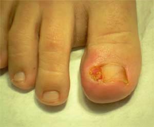 Unghia incarnita con granuloma.