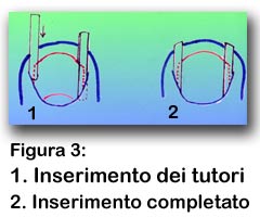 inserimento-tutori