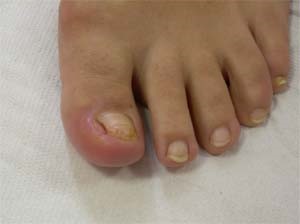 Unghia incarnita con granuloma (dopo pregressa caduta dell'unghia da trauma)