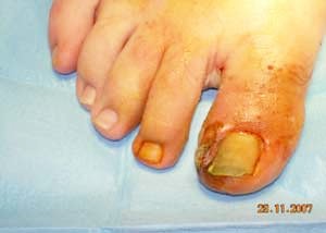 Unghia incarnita trattata altrove con Ossido giallo (notare le lesioni necrotiche e l'infiammazione della zona circostante)