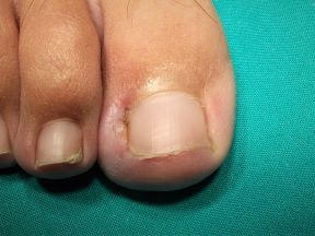 granuloma