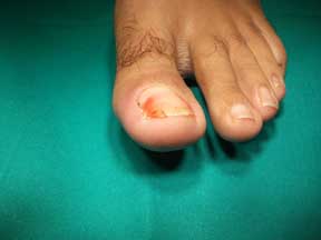 con iniziale granuloma