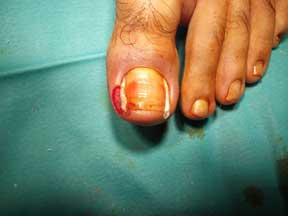 3Asportazionedelgranuloma e inserimento dei tutori